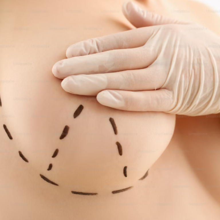 Mamoplastia